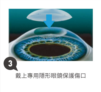 戴上專用隱形眼鏡保護傷口