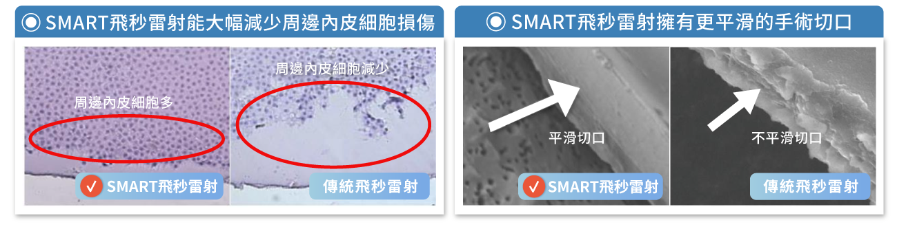 SMART飛秒雷射白內障優勢